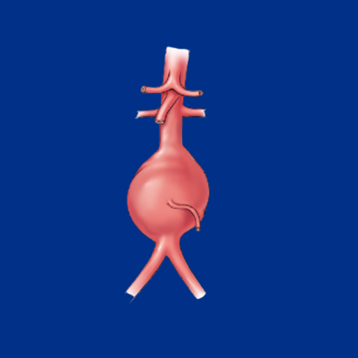 Image of Bulging Abdominal Aortic Valve